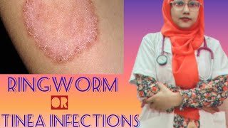 RingwormSings amp Symptoms of Tinea Infectionsringworm tinea tineainfectionsdermatophytosis [upl. by Jochebed]