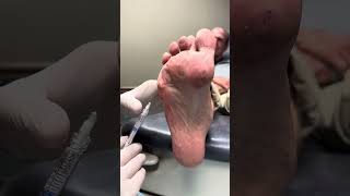 Radiesse dermal filler injections for pain on the ball of the foot [upl. by Asyal]