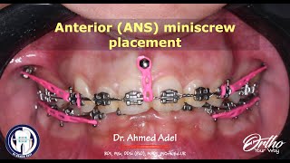 Anterior miniscrew ANS placement step by step by dr Ahmed Adel Orthodontics [upl. by Stover]