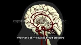 What Is A Stroke  Narration and Animation by Dr Cal Shipley MD [upl. by Fennelly]