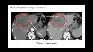 3 LIRADS Overview of CTMR algorithm and major features  Part 1 By Dr Victoria Chernyak [upl. by Nikolos]