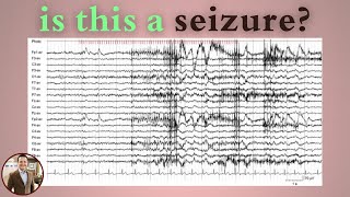 Photomyoclonic Response on EEG Not a Seizure Here’s Why [upl. by Rafael]