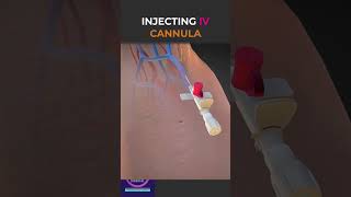 Injected IV Cannula With Sticking Plaster shorts education [upl. by Bywaters]