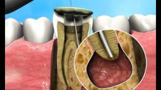 Treatment of Apical Periodontitis  a new approach [upl. by Carolus351]