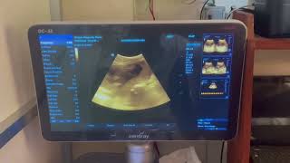 Pregnancy Profile Scanning Procedure For Beginners Step by Step BPDFLACAFI [upl. by Melleta]