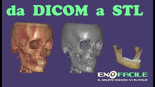 da DICOM a STL parte 1 [upl. by Kalin]