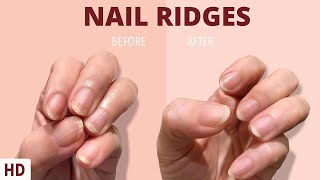 Nail Ridges The Silent Signaling Your Nails Are Trying to Tell You [upl. by Benedick]