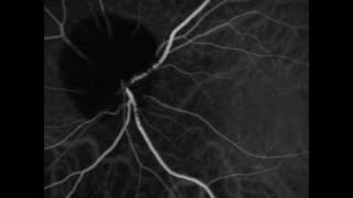 Ophthalmic Melanocytoma of the Optic Nerve [upl. by Hathaway]