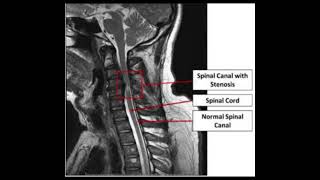 Spinal stenosis [upl. by Maxfield]