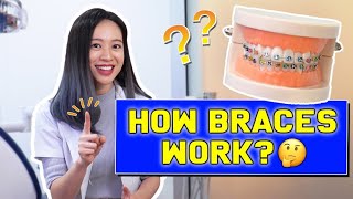 HOW Braces WORK  BraceYourself🦷 [upl. by Harbison]