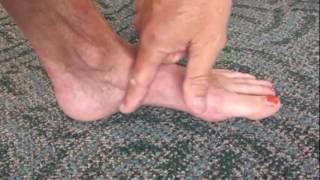 Sesamoid Evaluation and Treatments [upl. by Ellered101]