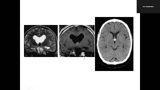 CNS spotting lecture 1 part 2 [upl. by Ahtenak253]