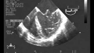 infective endocarditisTEE chordal rupture of both leaflets of the mitral valve [upl. by Cochard448]