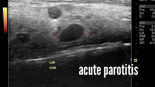 Acute parotitis ultrasound and color Doppler imaging video [upl. by Wetzel]