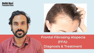 Frontal Fibrosing Alopecia FFA Diagnosis amp Treatment  DHTC  Dr Mukesh Manjhi [upl. by Lerrad249]