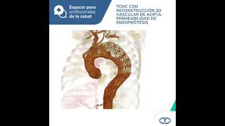 Espacio para profesionales  Disección aórtica tipo B tratada con endoprótesis Control por TC 3D [upl. by Rowan]