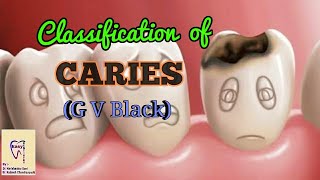 Dental Caries  Classification of dental caries  GV Black Classification [upl. by Lidda]