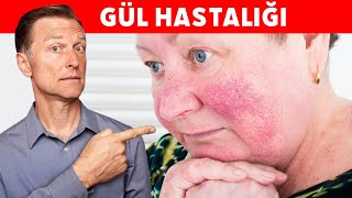 Gül hastalığı nedir Gül hastalığı tedavisi nasıl olur  DrBerg Türkçe [upl. by Egief]