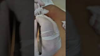 Cirurgia de Cisto Sebaceo ou Epidermico Sebaceous cyst on the back Surgical removal [upl. by Kerat]