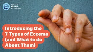 Introducing the 7 Types of Eczema and What to do About Them [upl. by Ranna]