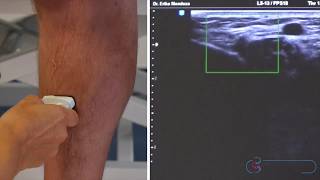 Krampfadern Diagnostik mit Ultraschall 1 [upl. by Ahsiekam]