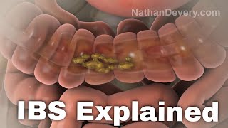 What is irritable bowel syndrome IBS explained [upl. by Sturrock352]