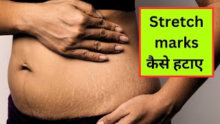 Stretch Marks Removal at Home ll Strech Marks Hone ke Karan ll Mital Chaudhari Ayurveda [upl. by Aristotle959]