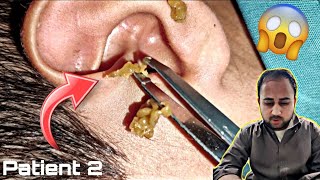 Ear Cleaning Opened Full ear infection  Ear wax Removal Part 2 [upl. by Aissak951]