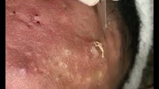 Pele com muita Acne  Limpeza de Pele Profunda  Clínica  Centro estética [upl. by Colman]