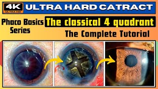 Ultra hard cataract  Demonstrating the 4 QUADRANT TECHNIQUE Phaco Basics  Dr Deepak Megur [upl. by Anual]