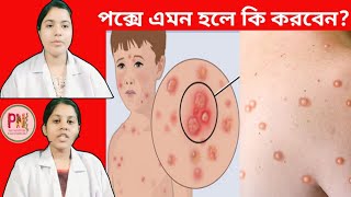 পক্স হলে করনীয় কি জেনে নিন  Pox Hole Ki Karoniyo  pox health [upl. by Foah988]