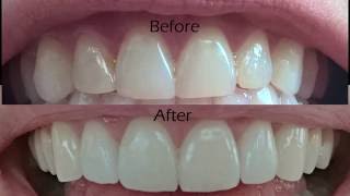 Dental Veneers Procedure Overview [upl. by Enyleve]