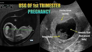 USG of 1st Trimester Pregnancy USG of pregnancy profile CMU  EXPLAINED IN BANGLA [upl. by Htebizile]