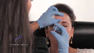 Botulinum Toxin  Injection Technique [upl. by Anneirb]