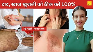 Fungal Infection क्या होता है Causes Symptoms and Treatment  Credihealth [upl. by Slater100]