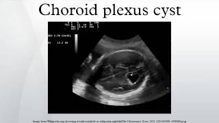 Choroid plexus cyst [upl. by Strander928]