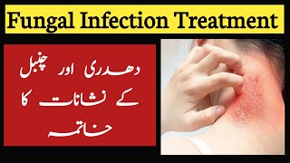 Dhadhar ka ilaj in urdu  Dhadhar skin problem treatment  Fungal infection treatment [upl. by Eanal32]