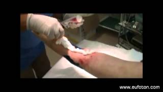 LASEmaR 800  Wound Healing Photobiomodulation and Debridement [upl. by Atat151]