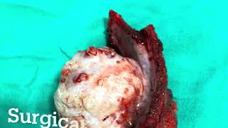 Chest Wall Tumor Excision with bone  mesh  LD flap reconstruction DrVedPrakashOnco [upl. by Eniluqaj965]