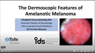 Amelanotic melanoma  Dr V Seiverling [upl. by Abihsat]