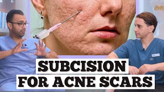 Subcision Acne Scars  Minor Surgery For Acne Scarring  Dr Somji amp Dr Solomon Explain Acne Scars [upl. by Enaujed858]