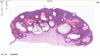 Seborrheic Keratosis Including Variants  Histopathology [upl. by Lalad]