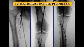 UCSF Vascular Surgery Symposium  Screening for Ischemia in the Diabetic Foot [upl. by Eibber]