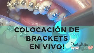 Colocación de Brackets en VIVO  Putting on Braces  LIVE [upl. by Rehpotsyrhc304]