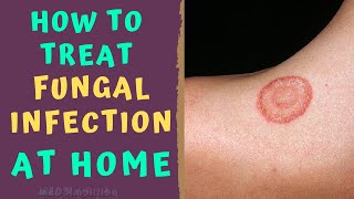 HOW TO TREAT SKIN FUNGAL INFECTION INFECTION AT HOME TINEA RINGWORM REMEDIES HOW TO CURE [upl. by Aleakim]