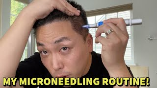 MY MICRONEEDLING ROUTINE TO TREAT HAIR LOSS [upl. by Rawley]