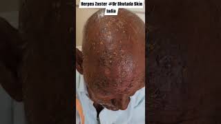 Herpes Zoster Dr Bhutada Skin India [upl. by Charmain]