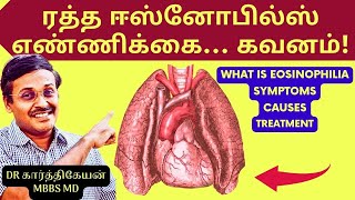 eosinophilia symptoms asthma allergy treatment tamil  Doctor Karthikeyan [upl. by Noral]