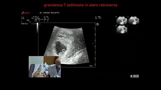 gravidanza alla settima settimana di gestazione [upl. by Acim]