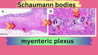 Schaumann bodies in Crohns disease [upl. by Berghoff]